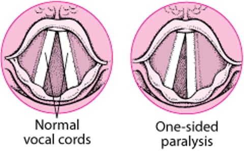 Parálisis de las cuerdas vocales