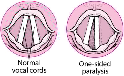 Paralysie des cordes vocales
