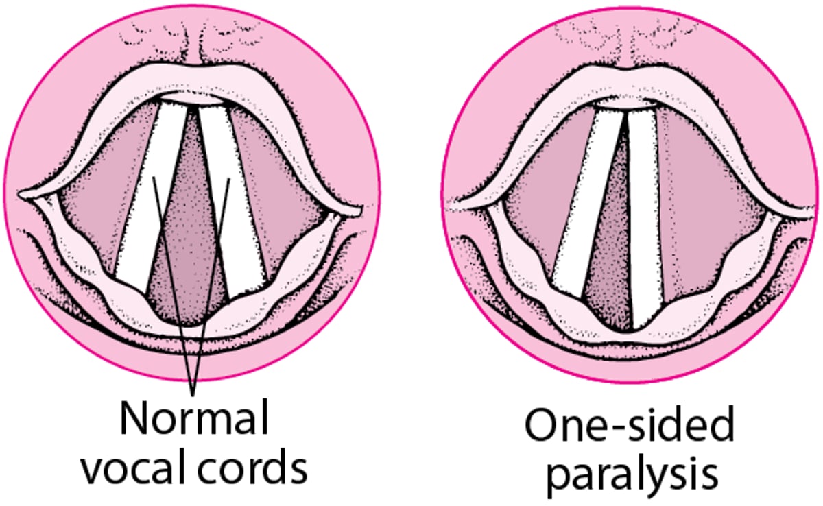 Paralysie des cordes vocales