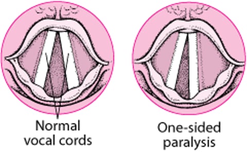Paralisia das cordas vocais