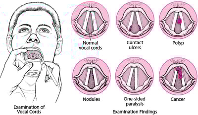 Vocal Cord Problems