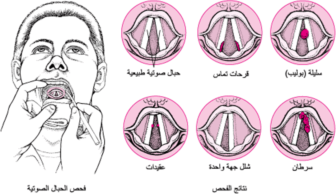 مشاكل الحبال الصوتية
