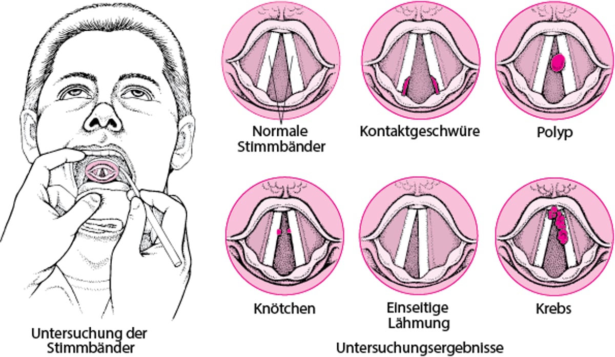 Probleme mit den Stimmbändern