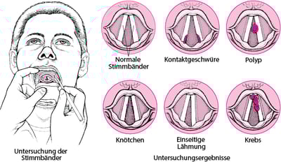 Probleme mit den Stimmbändern