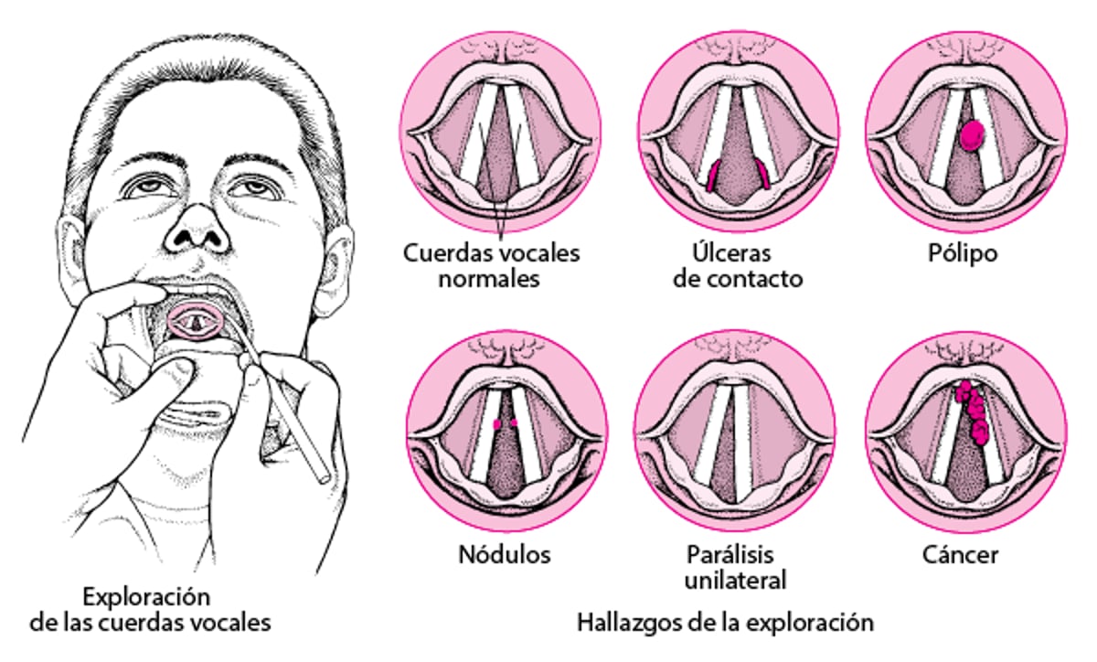 Problemas en las cuerdas vocales