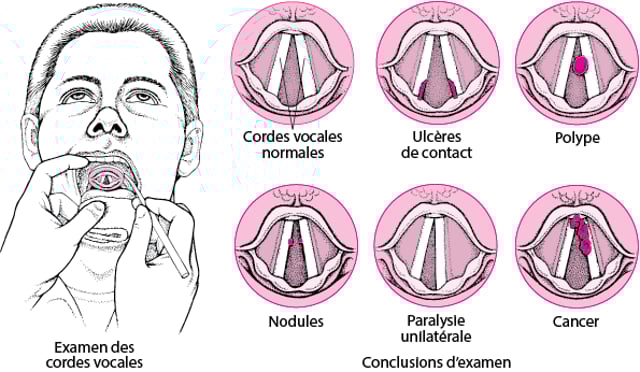 polypes-nodules-granulomes-et-papillomes-des-cordes-vocales