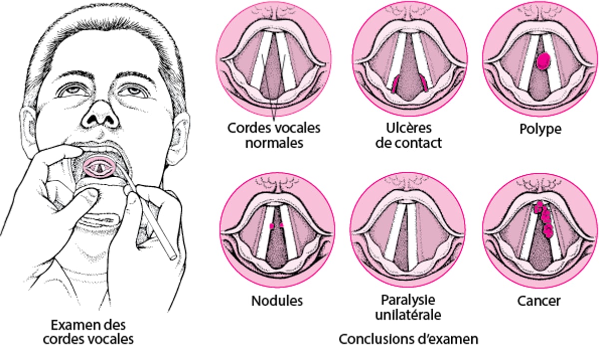 Problèmes de cordes vocales