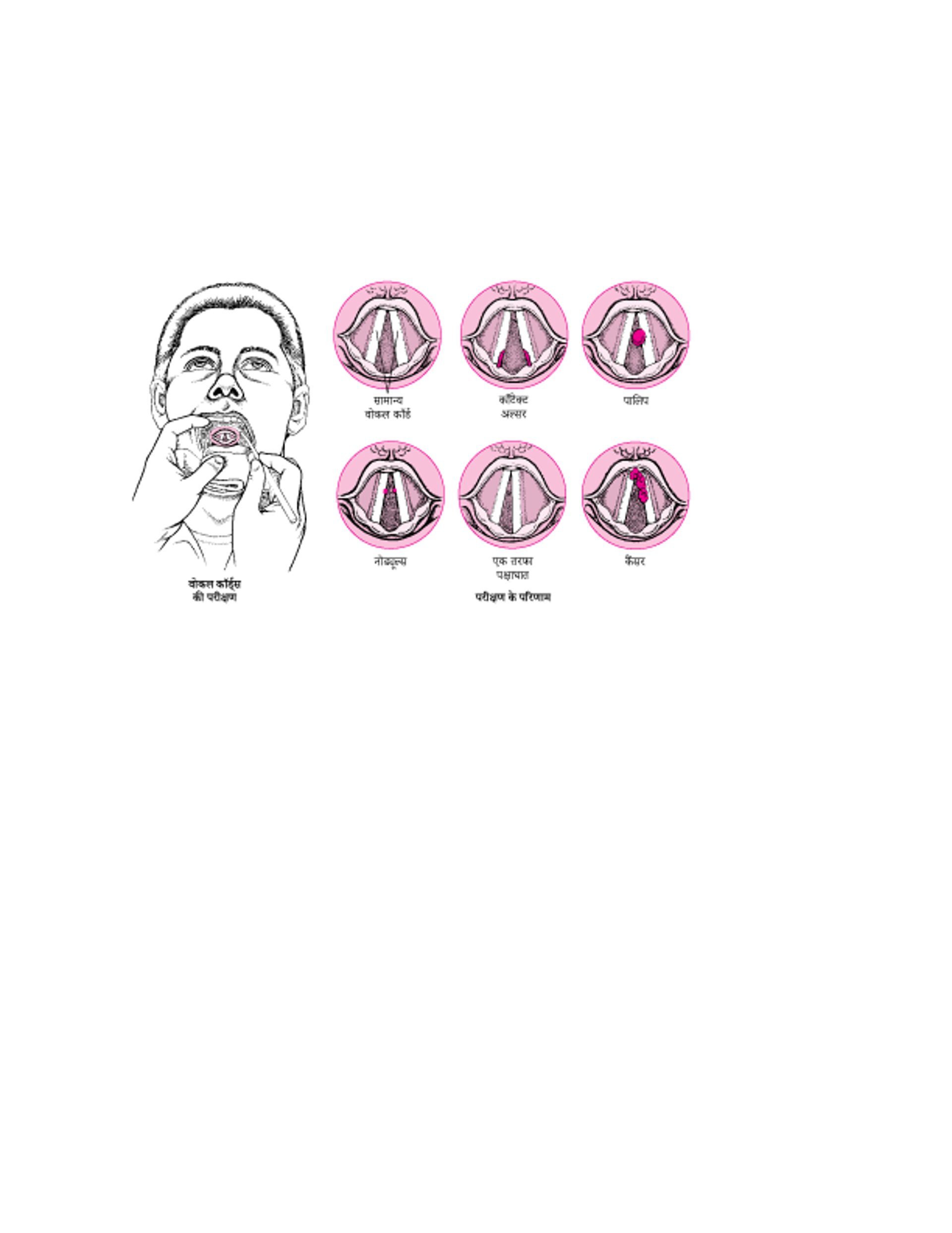 वोकल कॉर्ड की समस्याएं