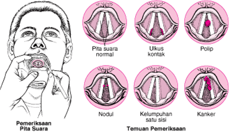 Masalah Pita Suara