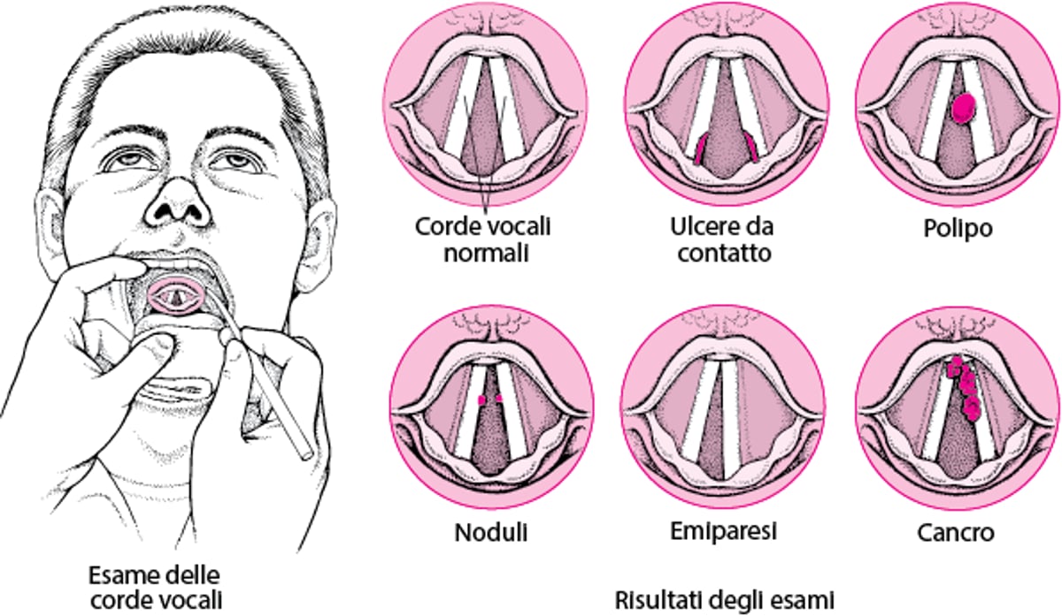 Problemi delle corde vocali