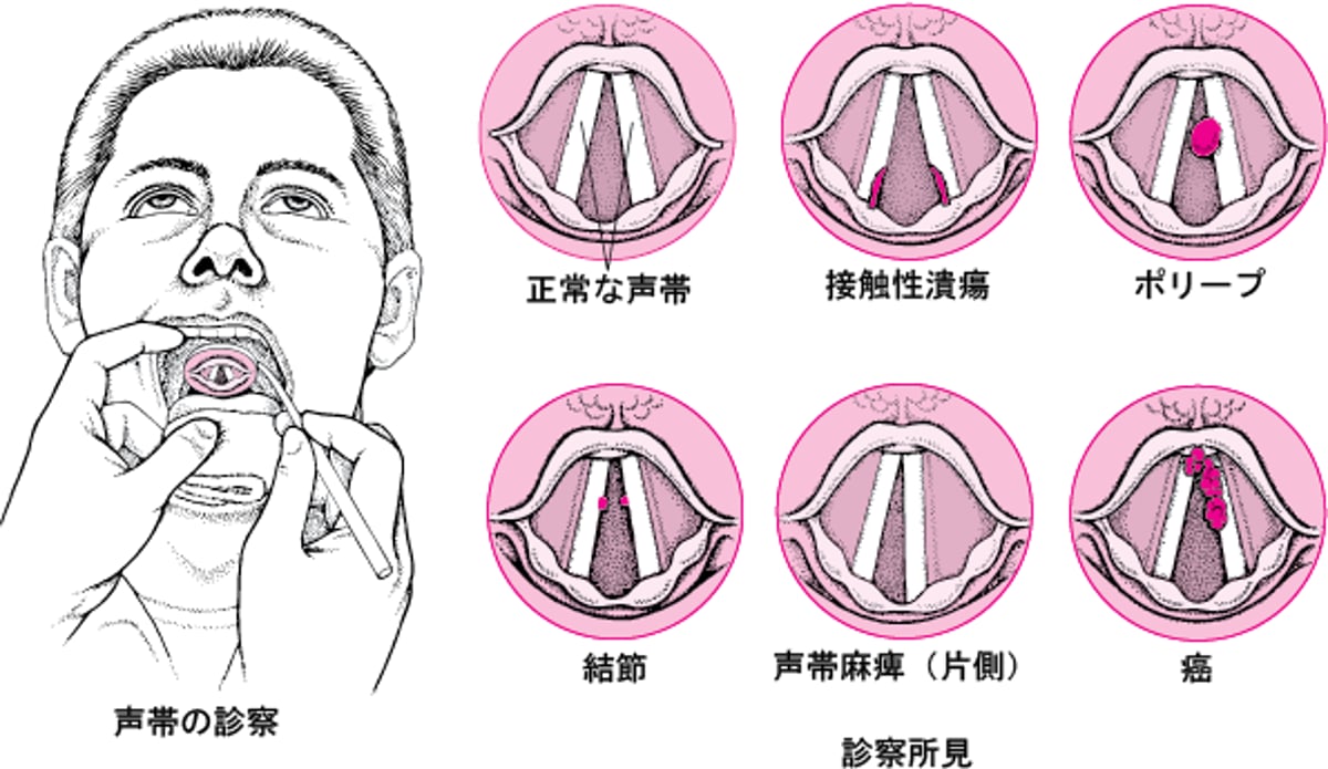 声帯の異常