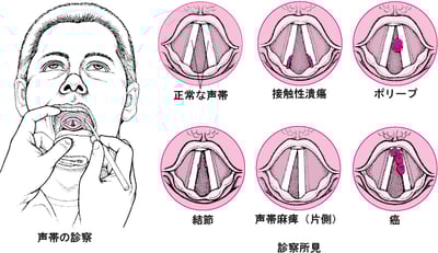 声帯の異常