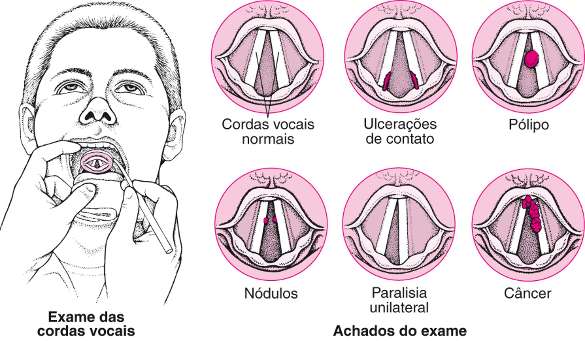 Problemas das cordas vocais