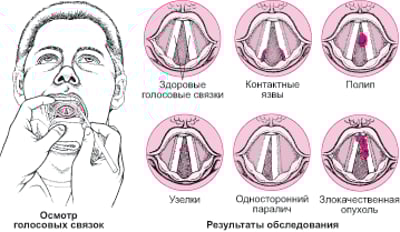 Заболевания голосовых связок