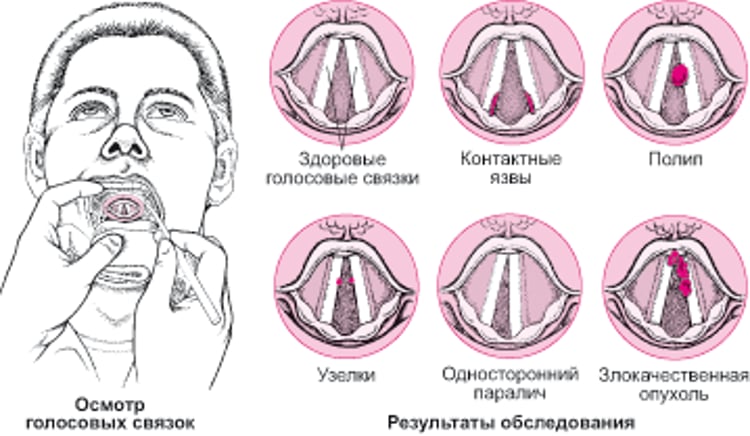 Заболевания голосовых связок