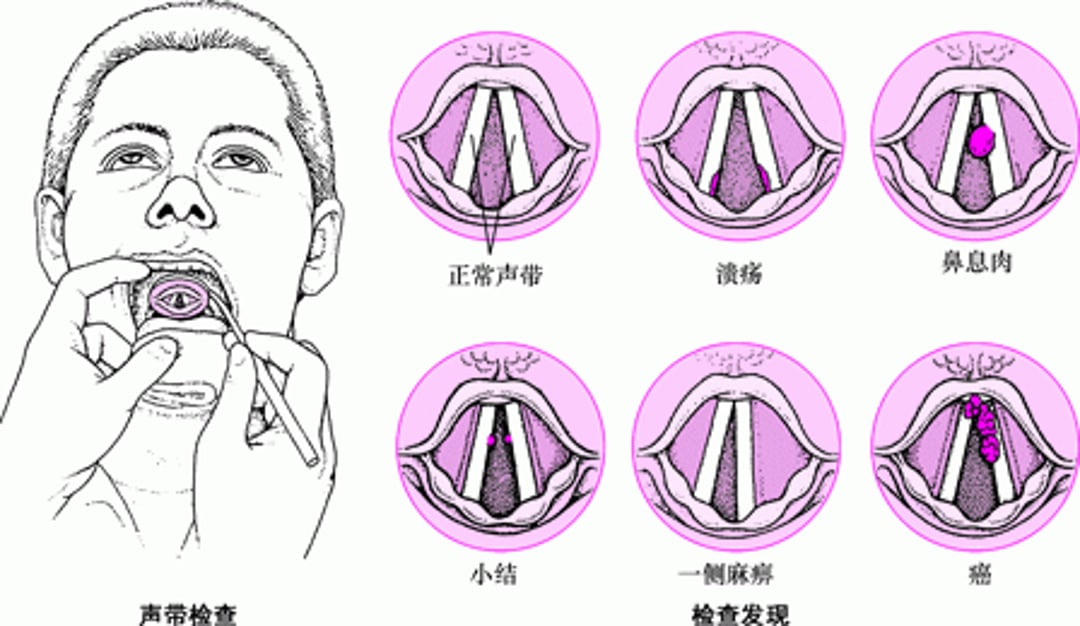 声带问题
