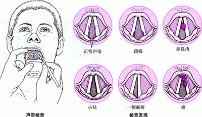 声带问题
