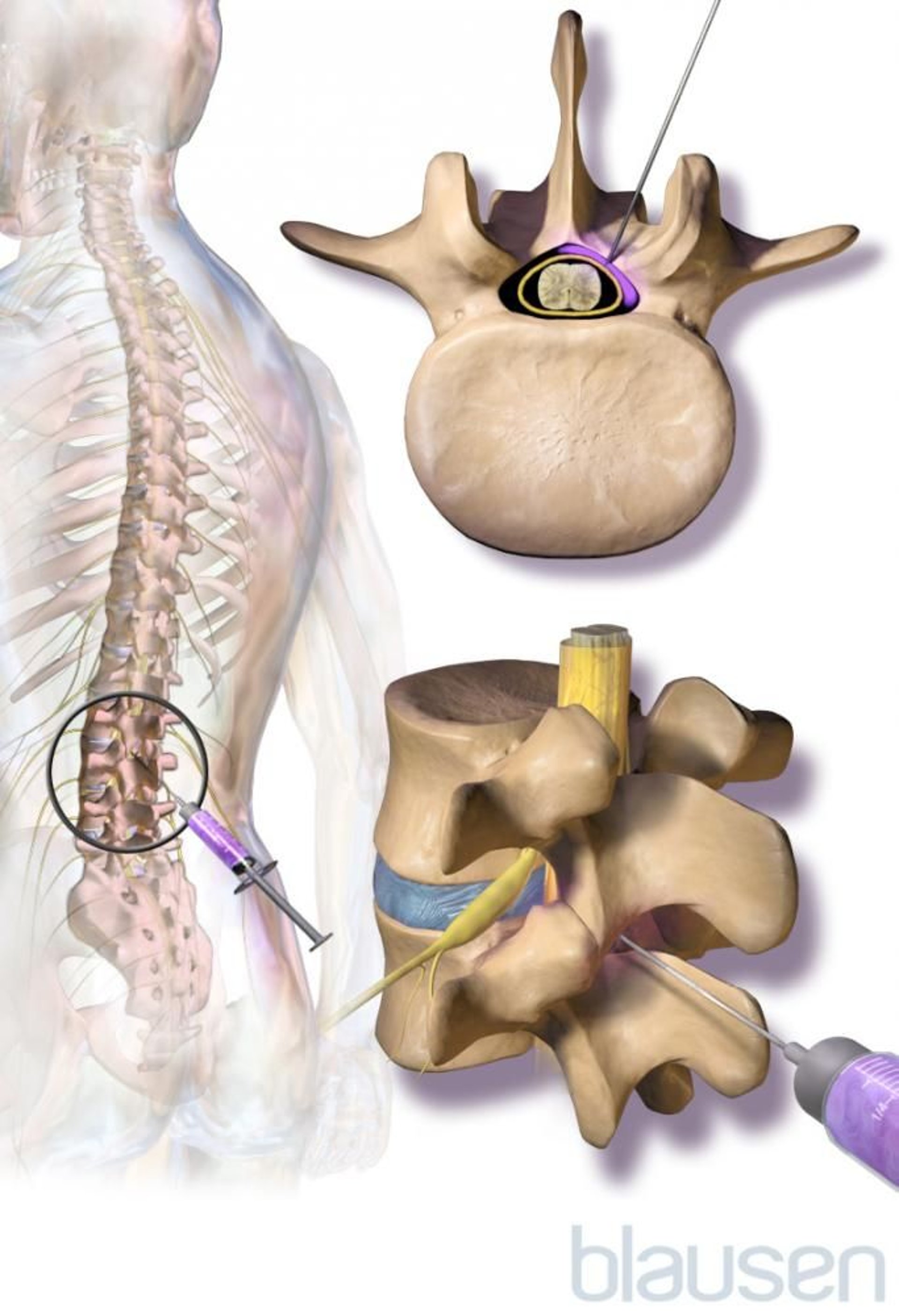 Injeção epidural de corticosteroide