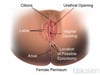 Episiotomy