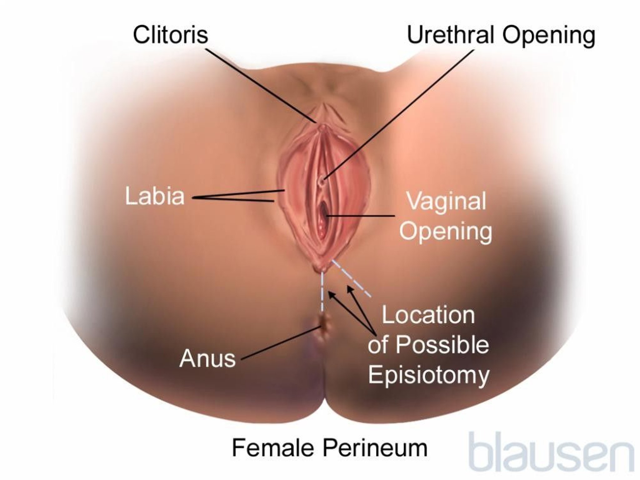 Episiotomy