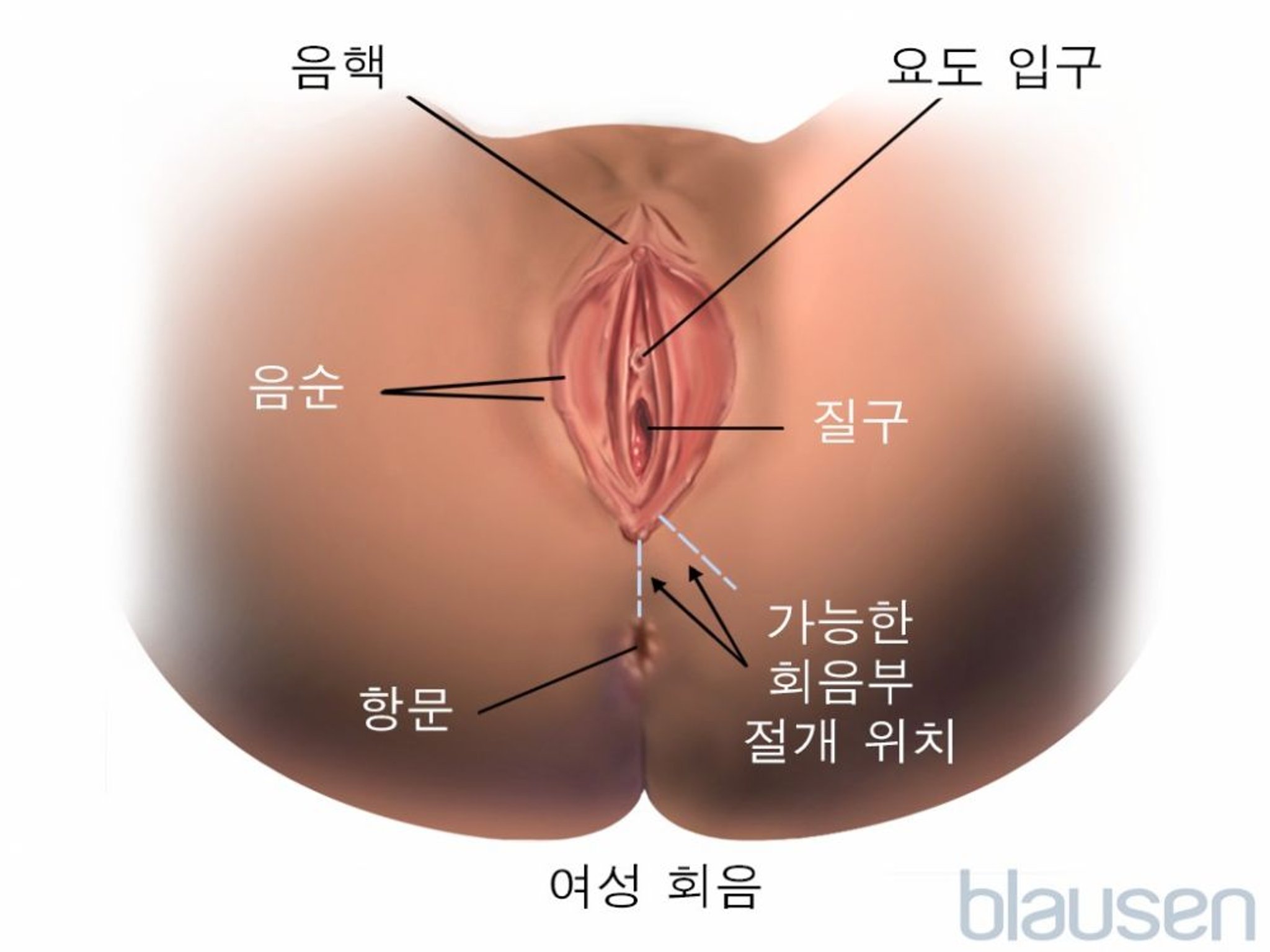 회음부 절개술