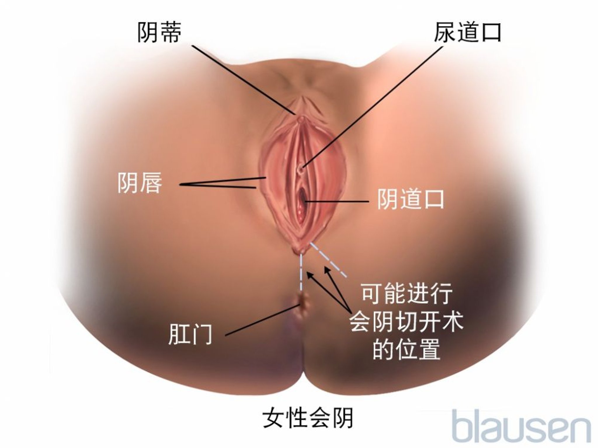 会阴切开术