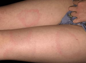The Rash of Lyme Disease (Erythema Migrans)