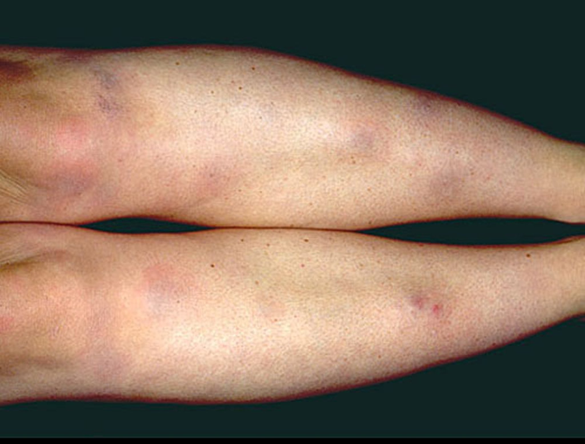 Erythema nodosum