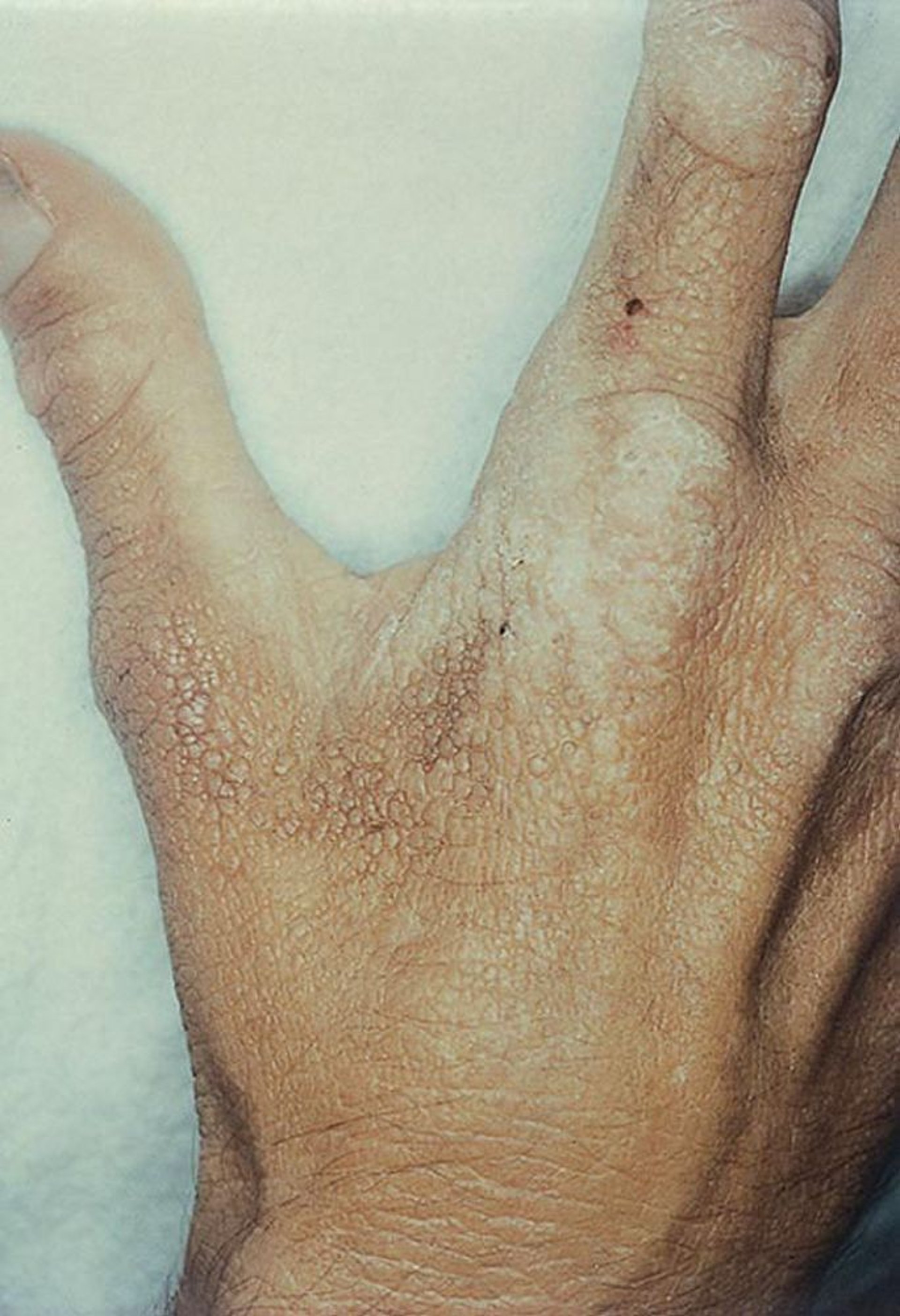 एरिथ्रोपोएटिक प्रोटोपोरफाइरिया