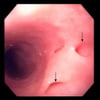 Diverticules œsophagiens