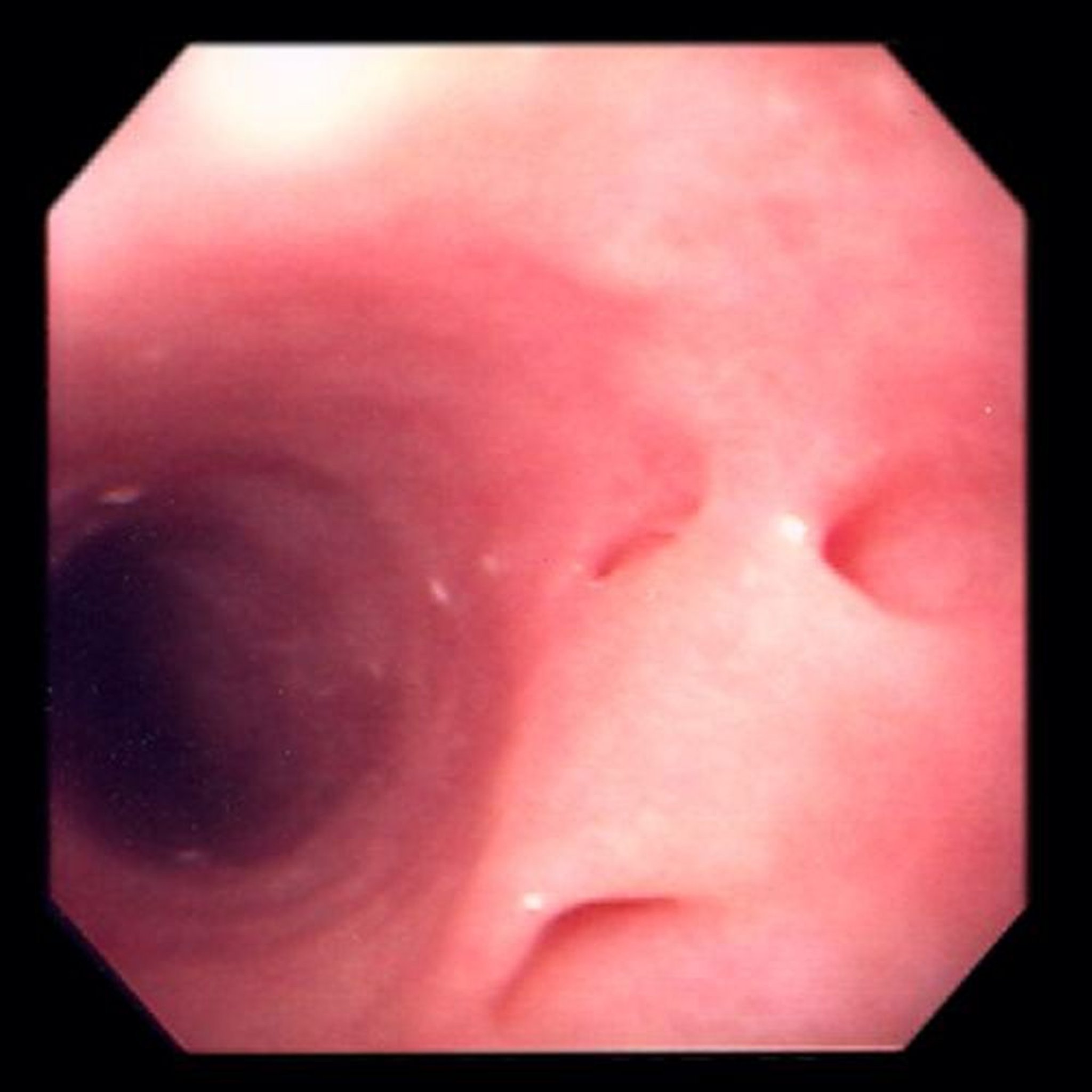 Bolsas esofágicas (divertículos)