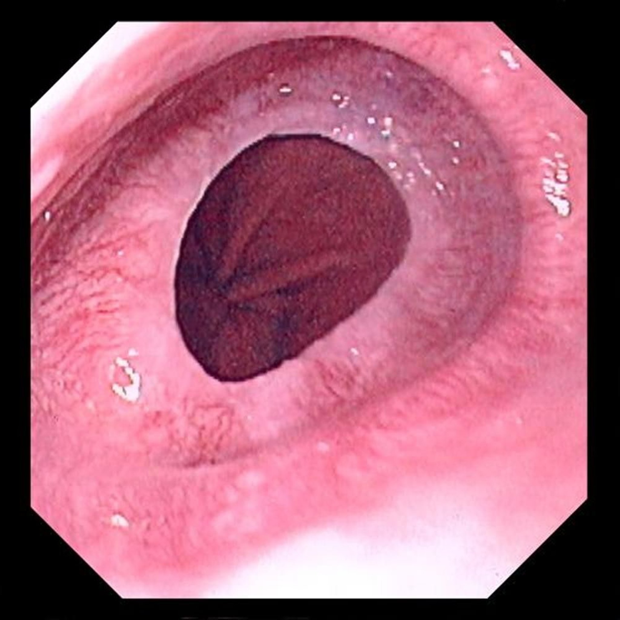 Esophageal Ring