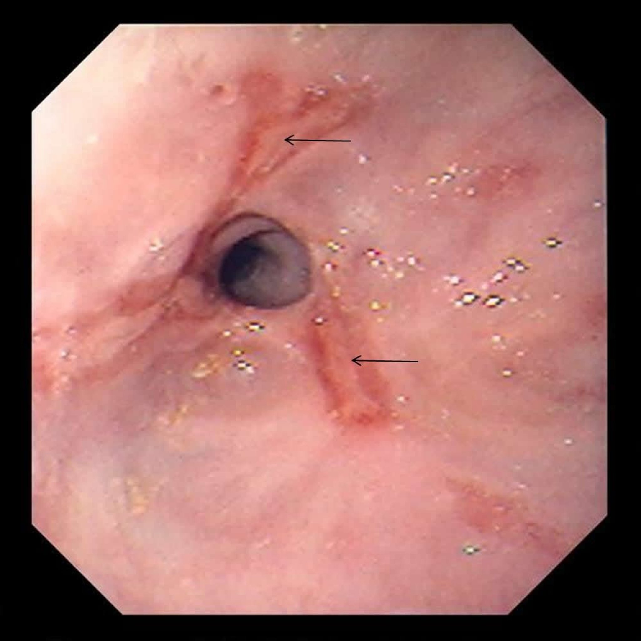 Narrowing (Stricture) of the Esophagus