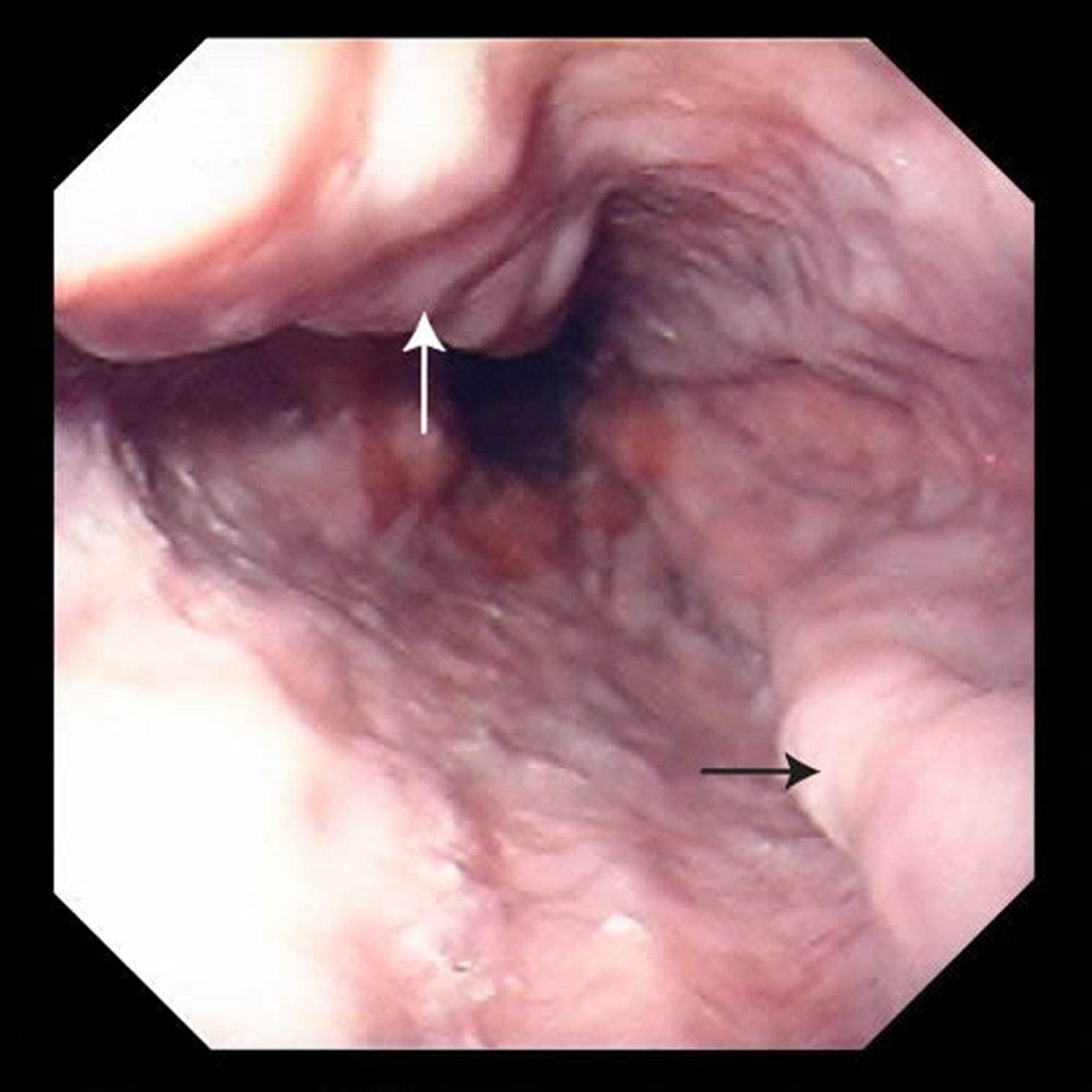 Enlarged Veins in the Esophagus (Esophageal Varices)