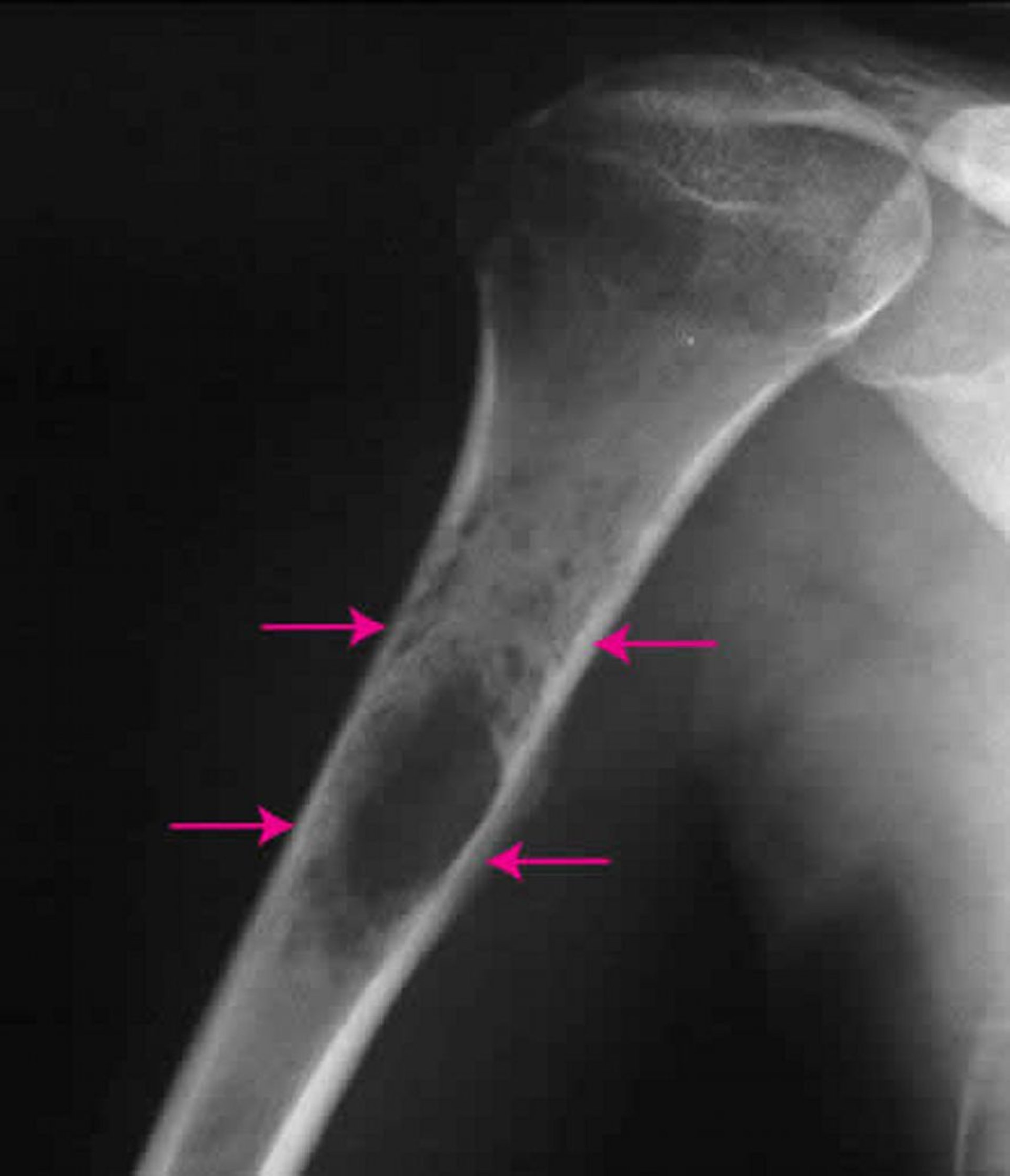 Sarcoma óseo de Ewing