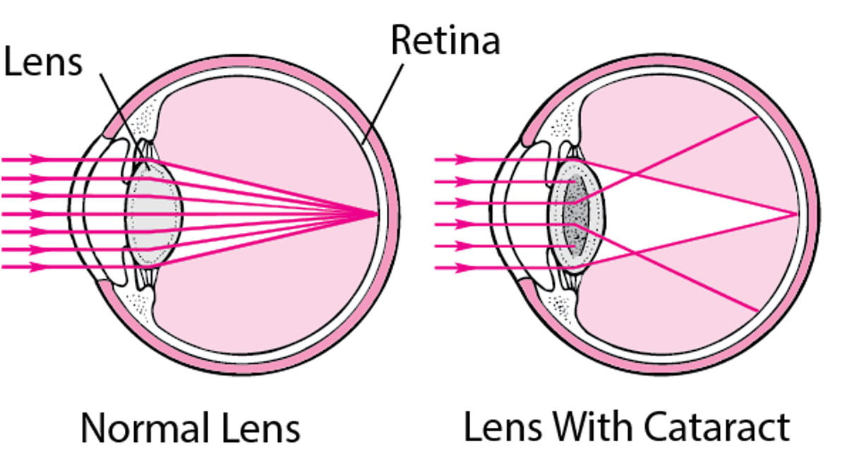How Cataracts Affect Vision