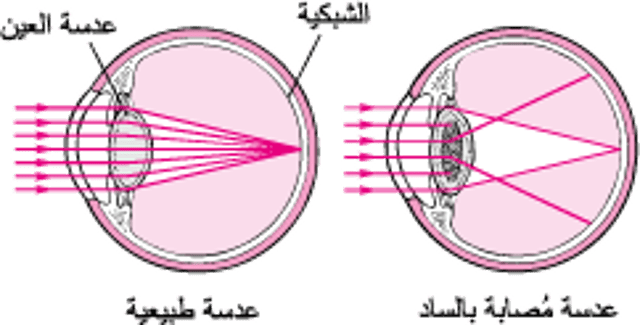 كيف يؤثر السادّ العيني في الرؤية