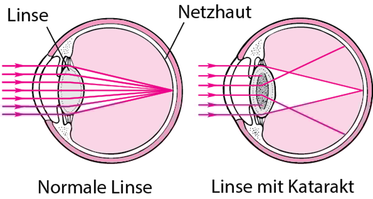 Wie Katarakte die Sehkraft beeinträchtigen