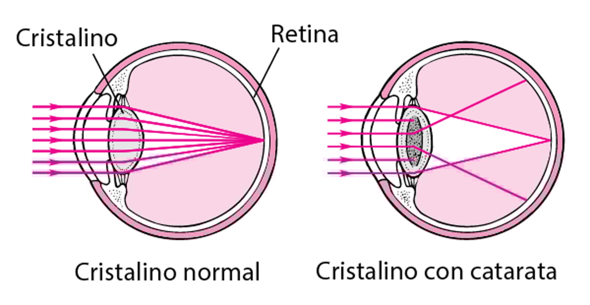 Cómo afectan la visión las cataratas
