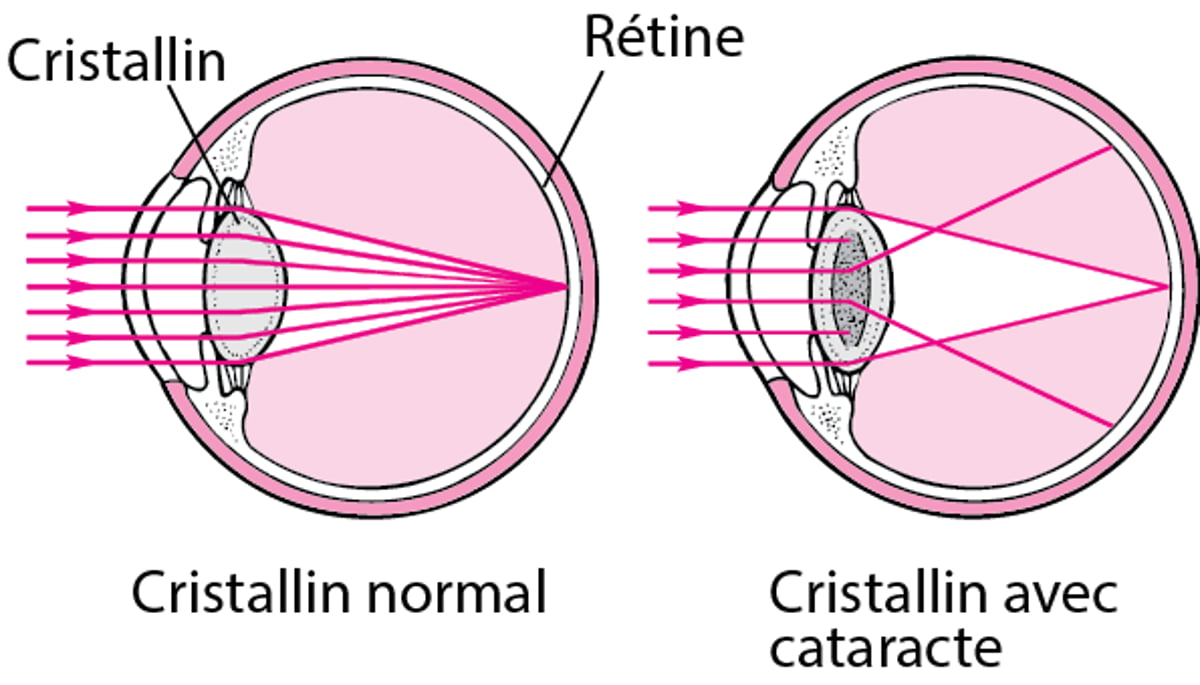 Comment la cataracte affecte-t-elle la vision