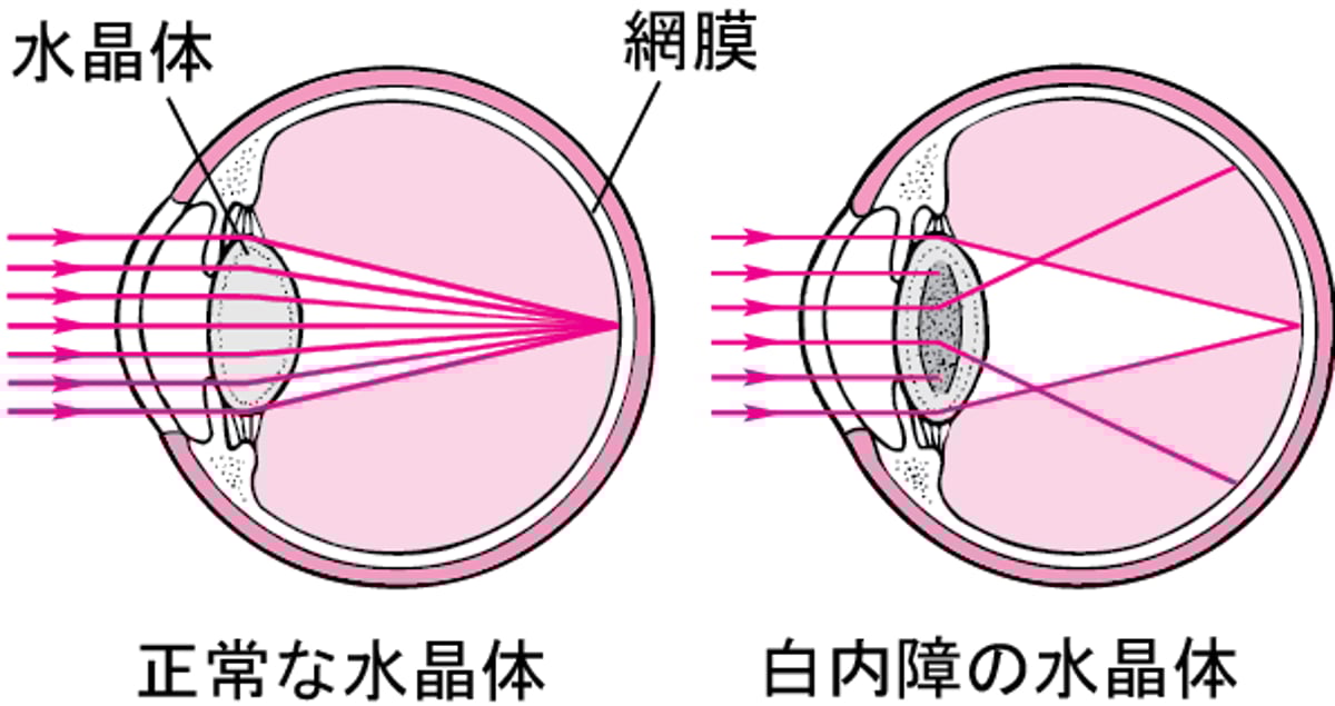 白内障はどのように視力に影響を与えるのでしょうか
