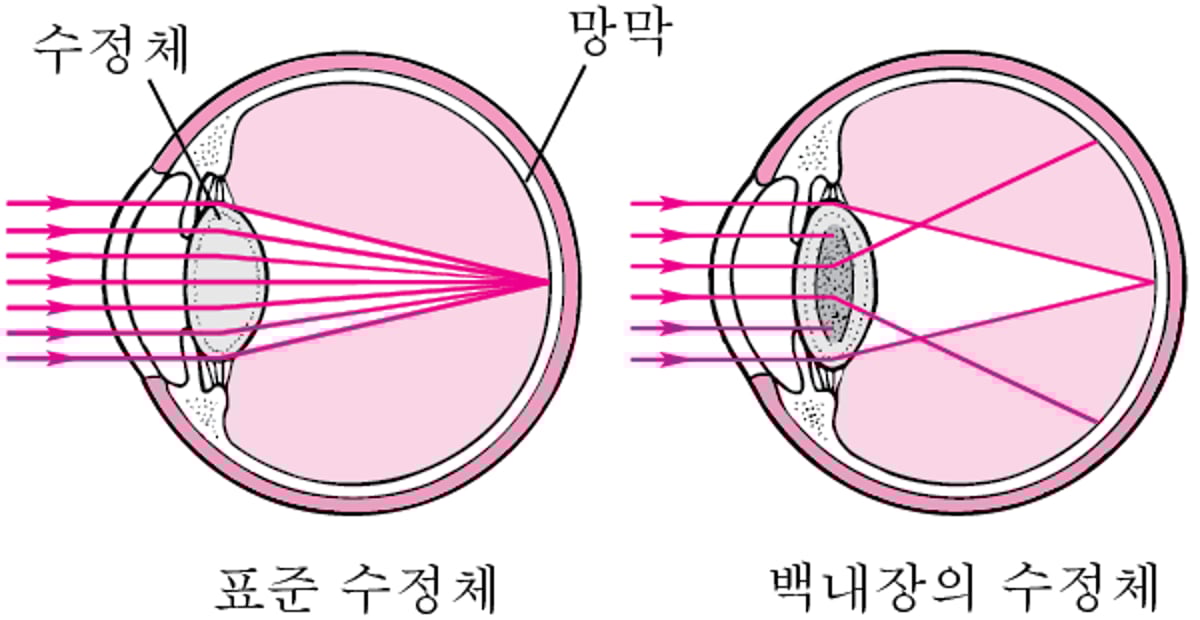 백내장이 시력에 미치는 영향