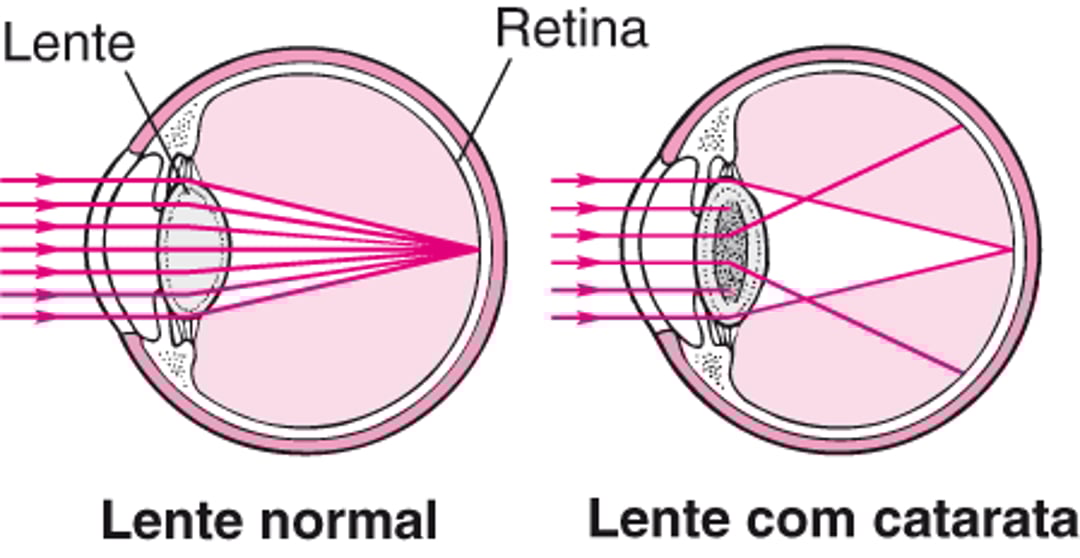 Como a catarata afeta a visão