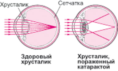 Как катаракта влияет на зрение
