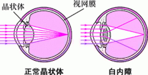 白内障如何影响视力