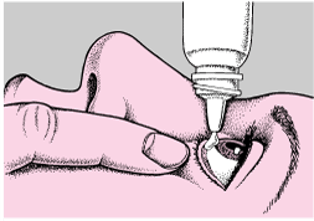 Uso de gotas y pomadas para los ojos