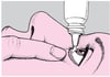 Utilisation de collyres et de pommades ophtalmiques
