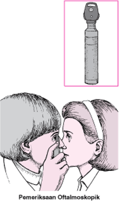 Apa yang dimaksud dengan Oftalmoskop?