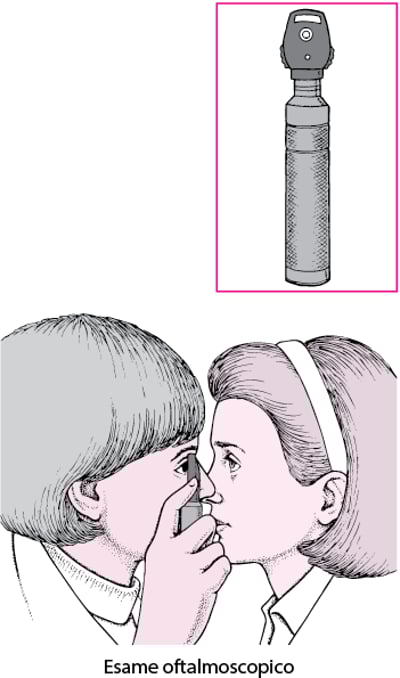 Cos’è un oftalmoscopio?