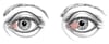 Pinguecula and Pterygium